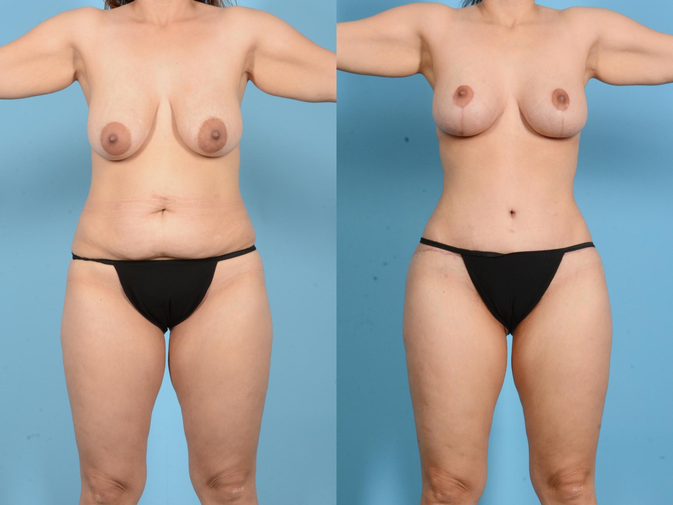 Before & After Brazilian Butt Lift Case 18134 Front View in Houston, TX