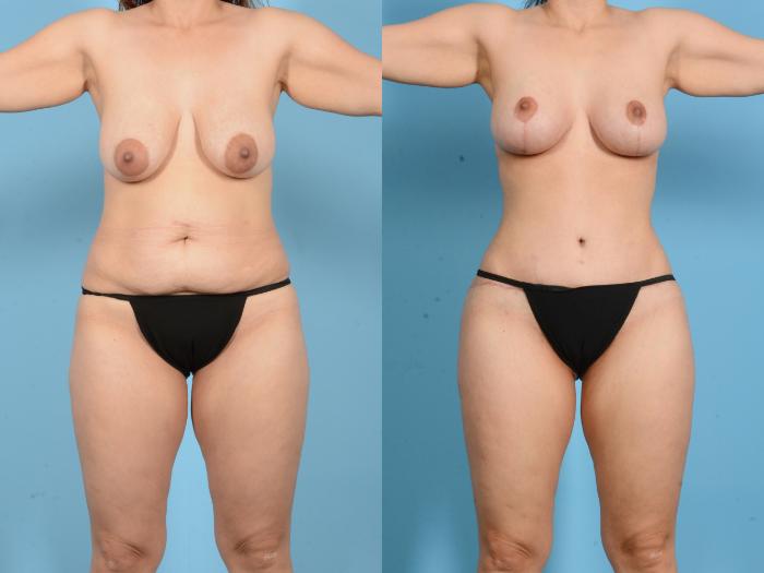 Before & After Brazilian Butt Lift Case 18134 Front View in Houston, TX