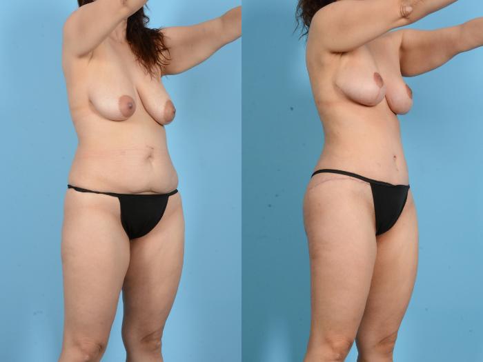 Before & After Brazilian Butt Lift Case 18134 Right Oblique View in Houston, TX