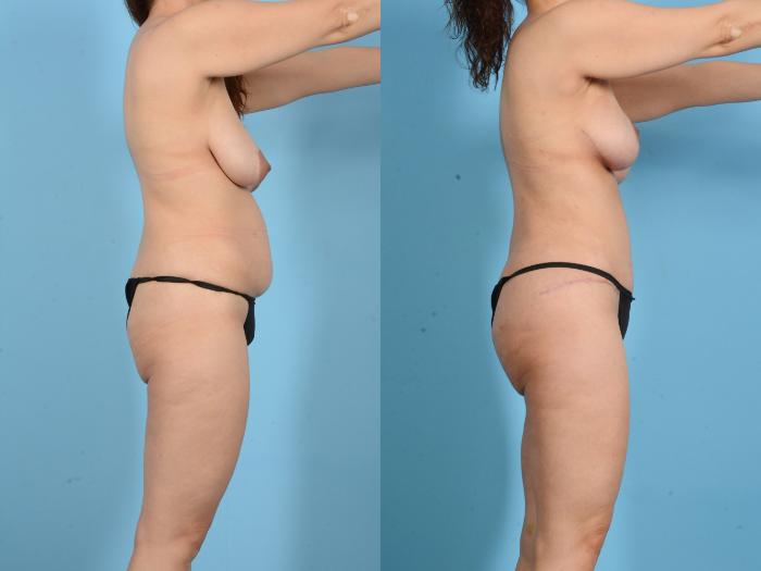 Before & After Brazilian Butt Lift Case 18134 Right Side View in Houston, TX