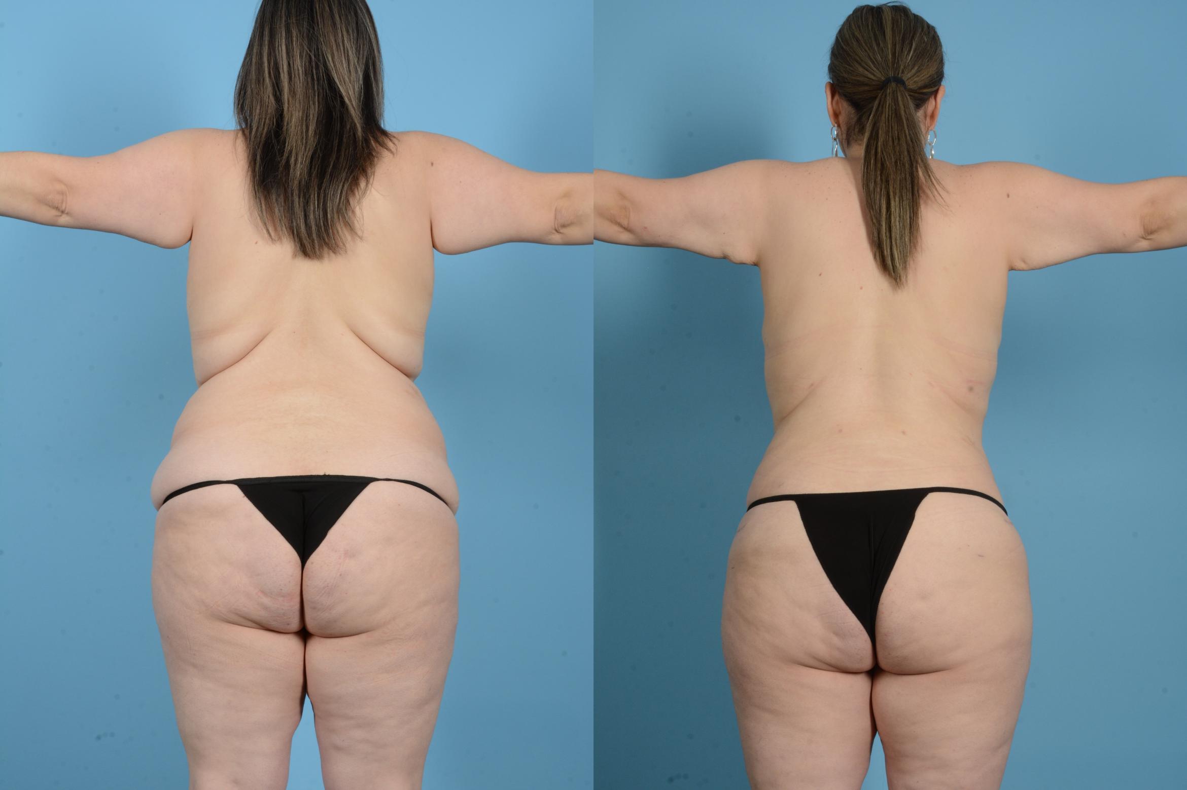 Before & After Tummy Tuck Case 18137 Back View in Houston, TX