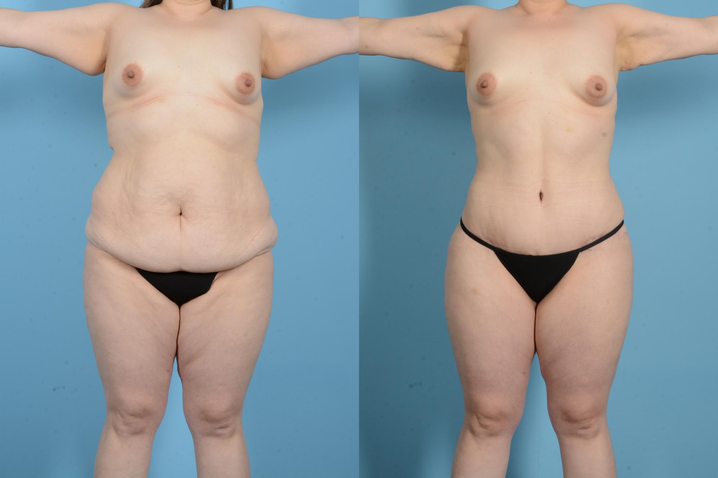 Before & After Tummy Tuck Case 18137 Front View in Houston, TX