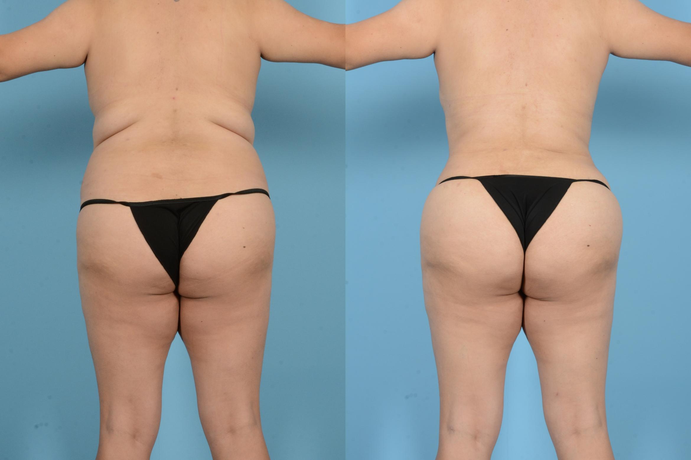 Before & After Liposuction Case 18144 Back View in Houston, TX