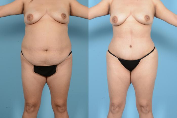 Before & After Liposuction Case 18144 Front View in Houston, TX
