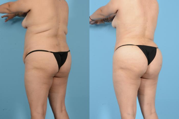 Before & After Liposuction Case 18144 Left Back Oblique View in Houston, TX