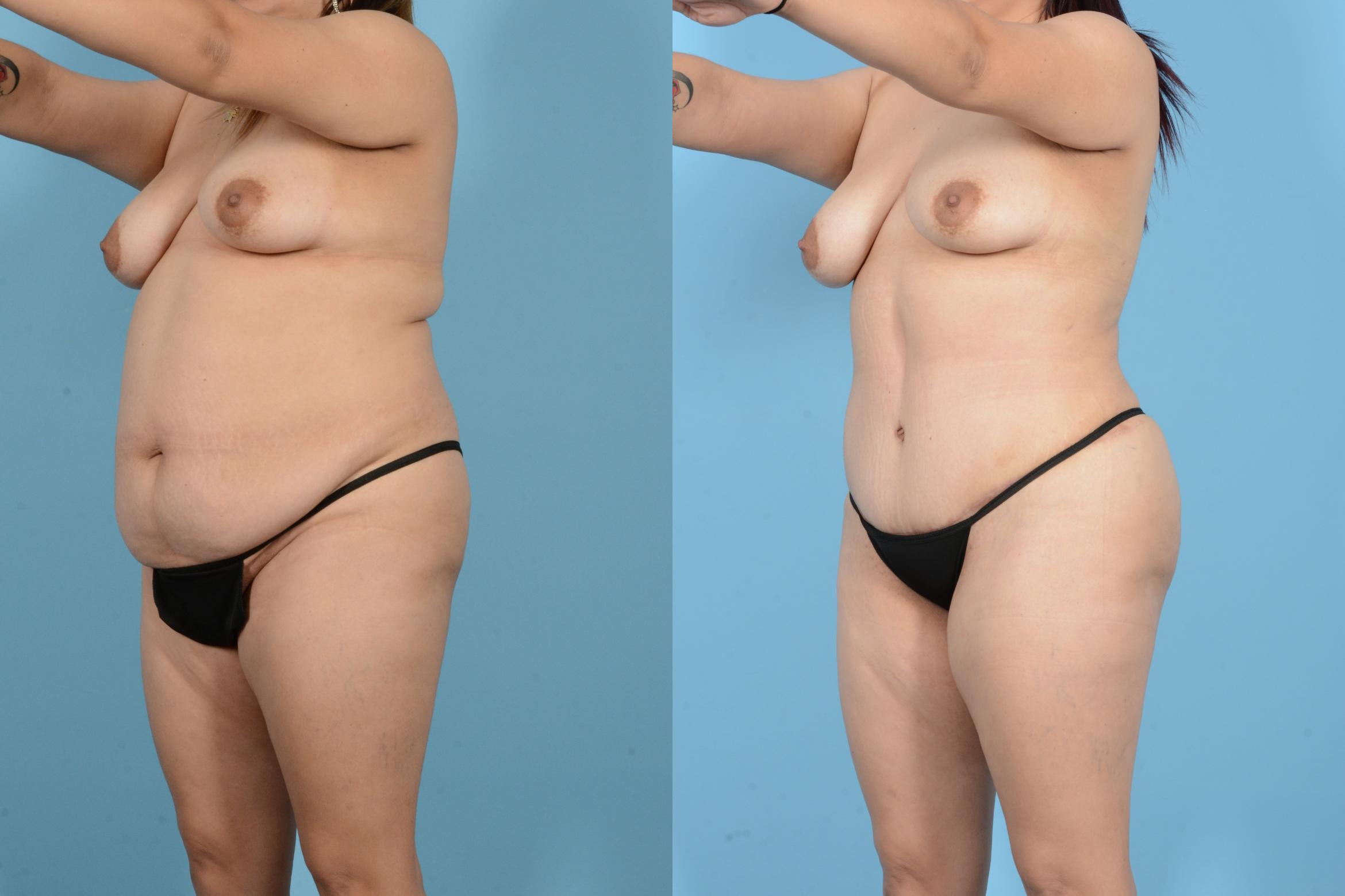 Before & After Liposuction Case 18144 Left Front Oblique View in Houston, TX