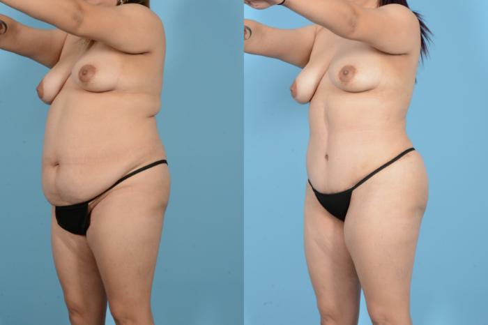 Before & After Liposuction Case 18144 Left Front Oblique View in Houston, TX