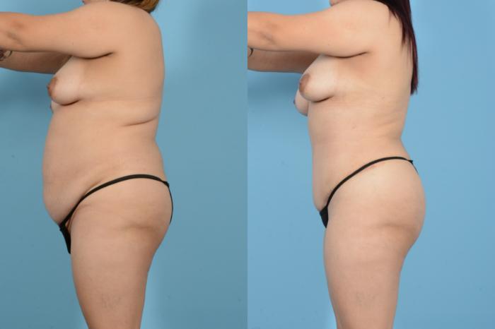 Before & After Liposuction Case 18144 Left Side View in Houston, TX