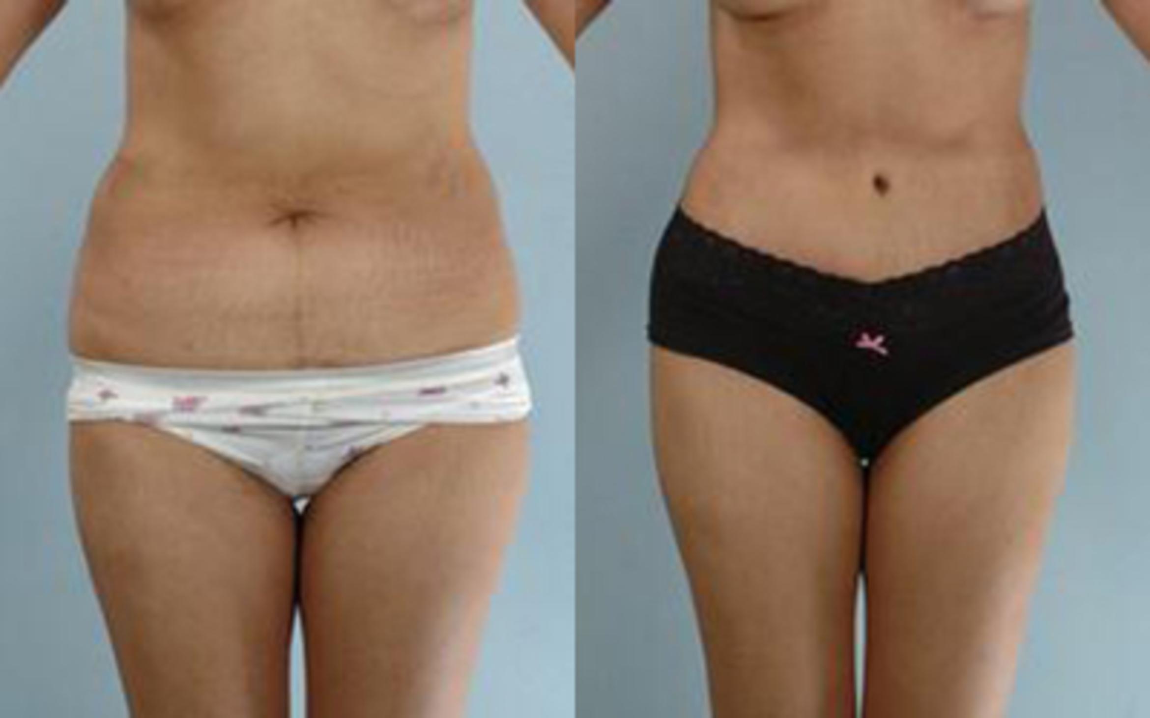Before & After Tummy Tuck Case 19 View 1 View in Houston, TX