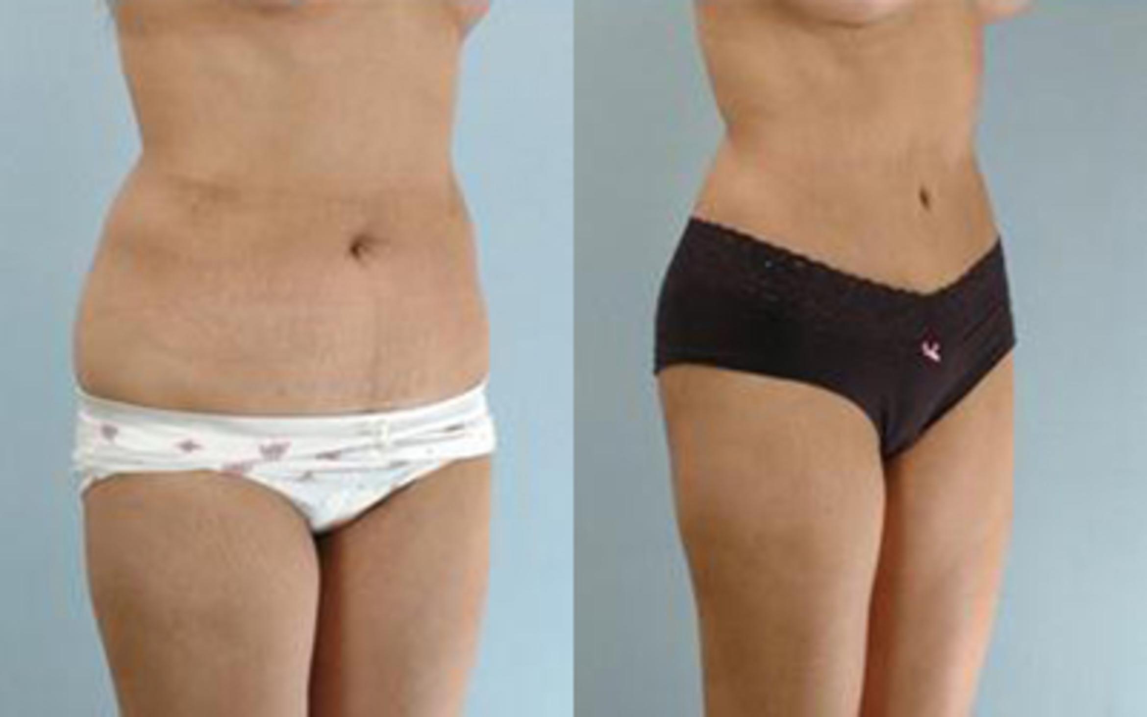 Before & After Tummy Tuck Case 19 View 2 View in Houston, TX