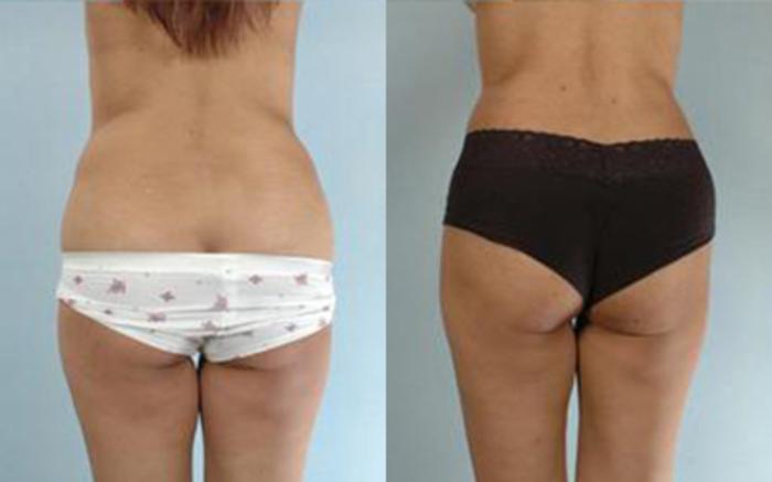Before & After Tummy Tuck Case 19 View 4 View in Houston, TX