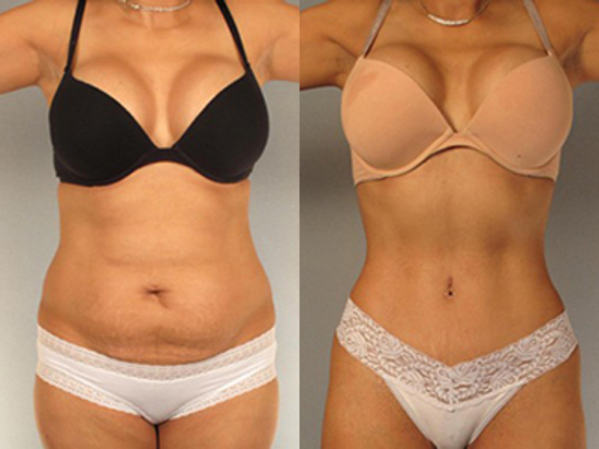 Before & After Tummy Tuck Case 2 View 1 View in Houston, TX