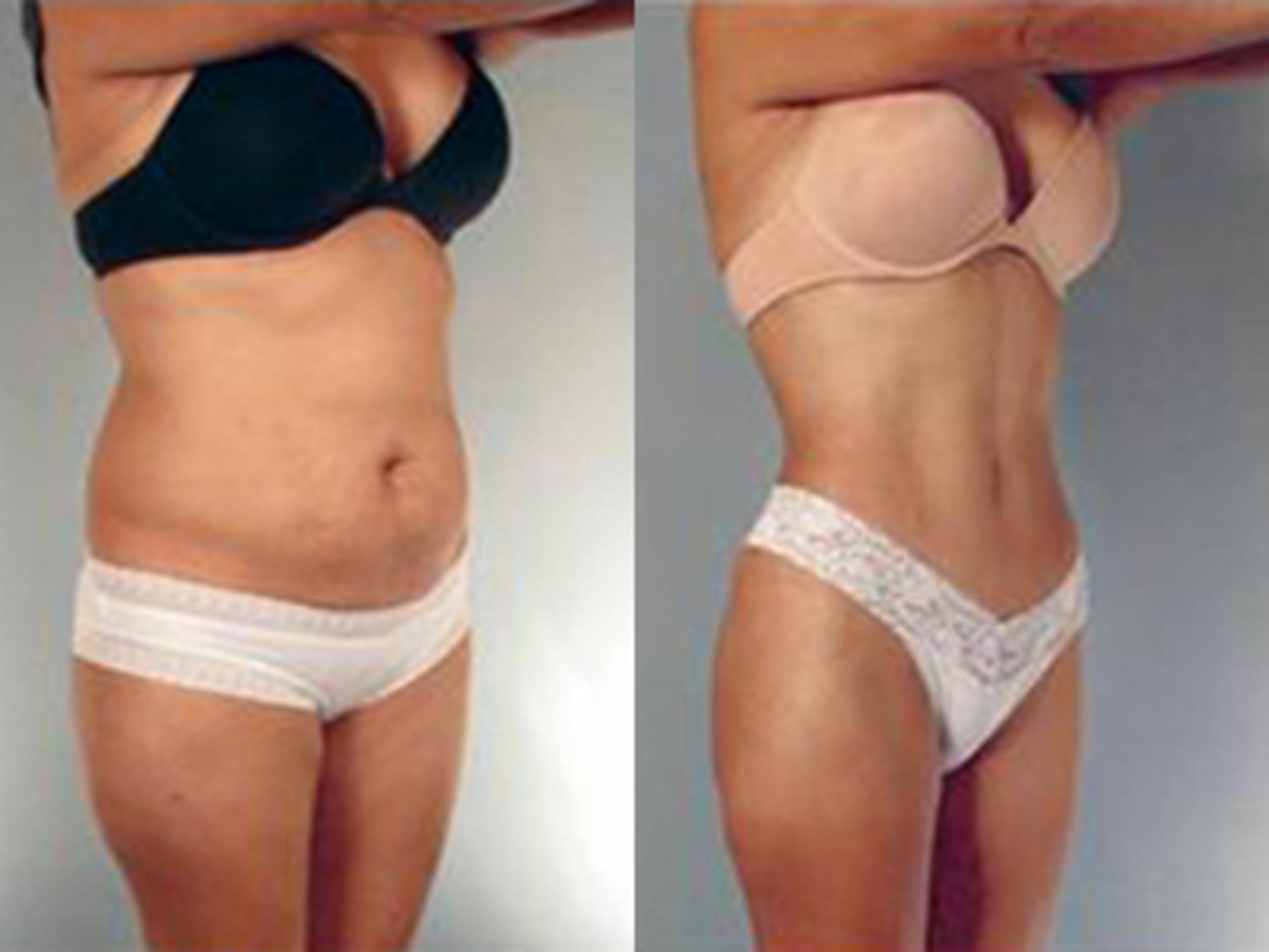 Before & After Tummy Tuck Case 2 View 2 View in Houston, TX