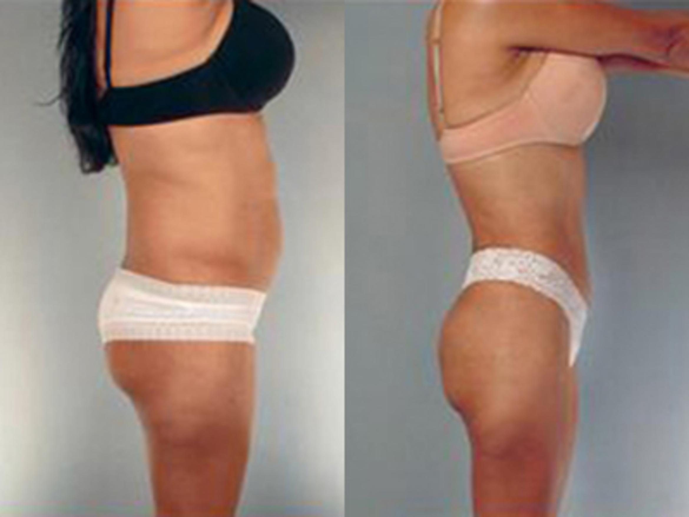 Before & After Tummy Tuck Case 2 View 3 View in Houston, TX