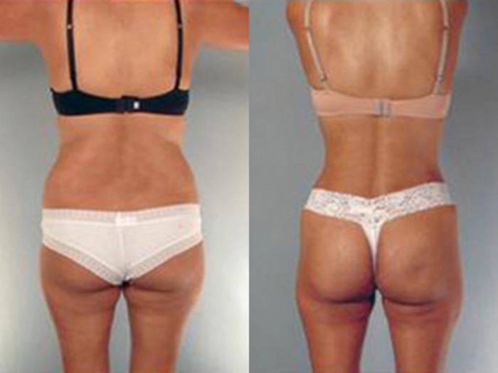 Before & After Tummy Tuck Case 2 View 4 View in Houston, TX