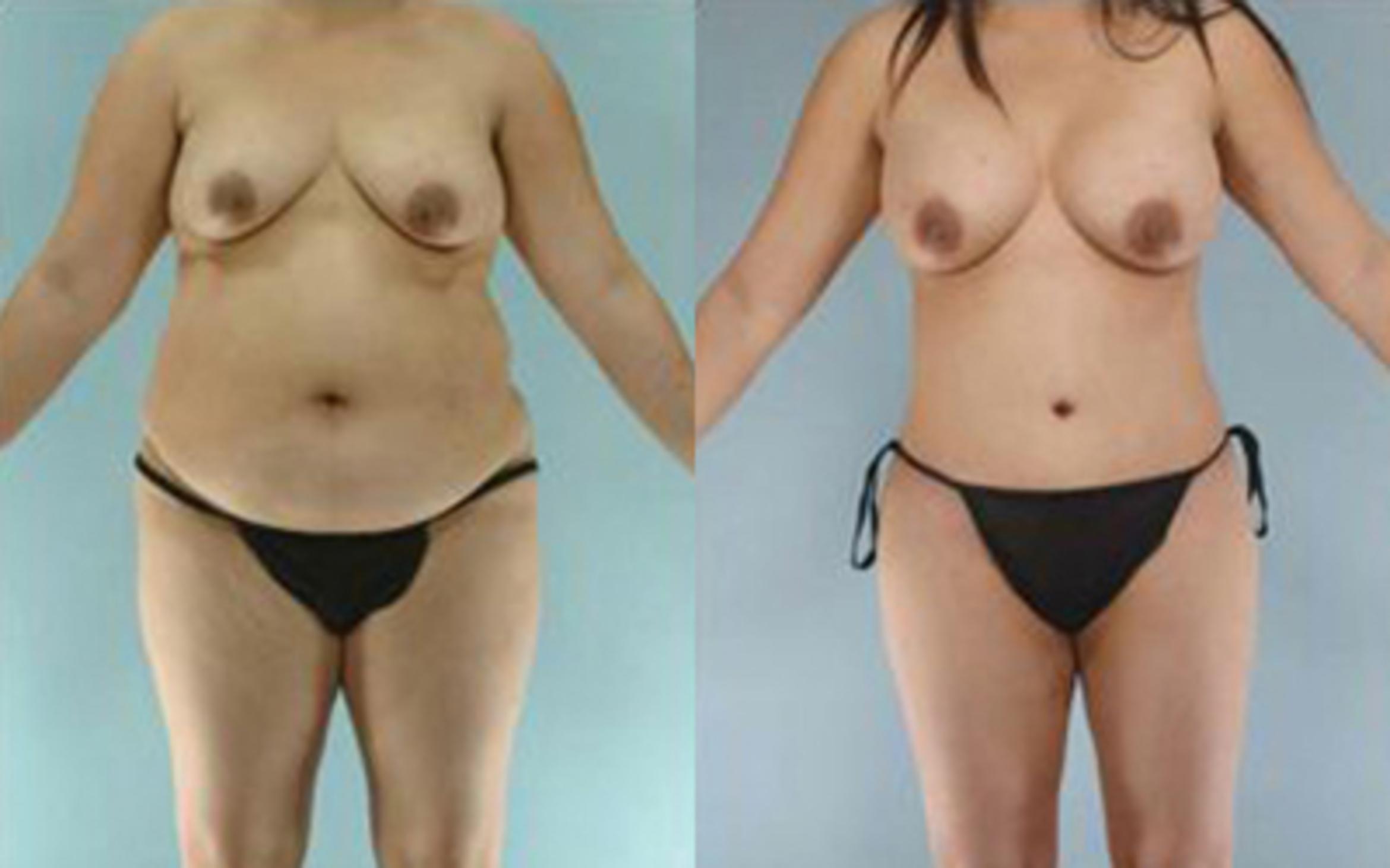 Before & After Tummy Tuck Case 20 View 1 View in Houston, TX