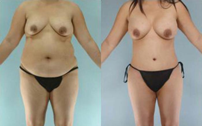 Before & After Tummy Tuck Case 20 View 1 View in Houston, TX
