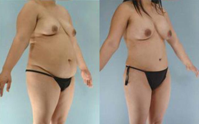 Before & After Tummy Tuck Case 20 View 2 View in Houston, TX