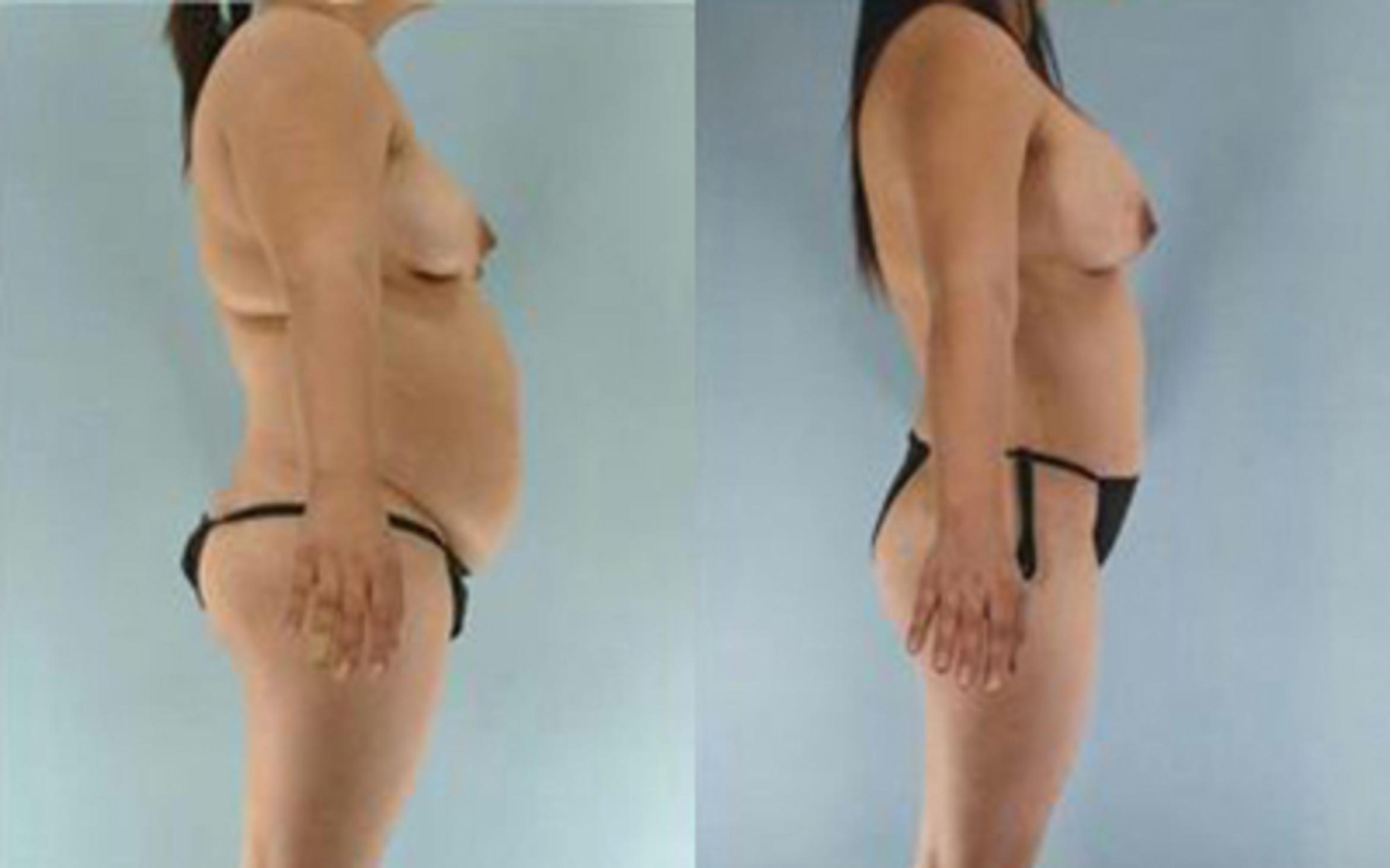 Before & After Tummy Tuck Case 20 View 3 View in Houston, TX