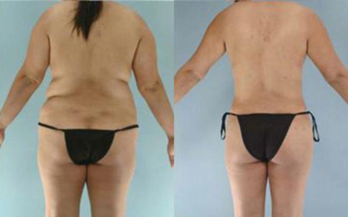 Before & After Tummy Tuck Case 20 View 4 View in Houston, TX
