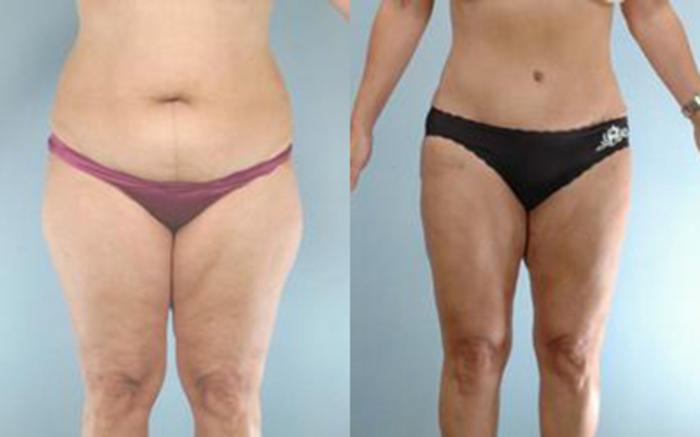 Before & After Tummy Tuck Case 21 View 1 View in Houston, TX