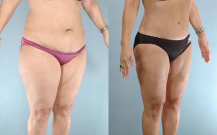 Before & After Tummy Tuck Case 21 View 2 View in Houston, TX