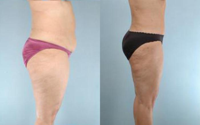 Before & After Tummy Tuck Case 21 View 3 View in Houston, TX