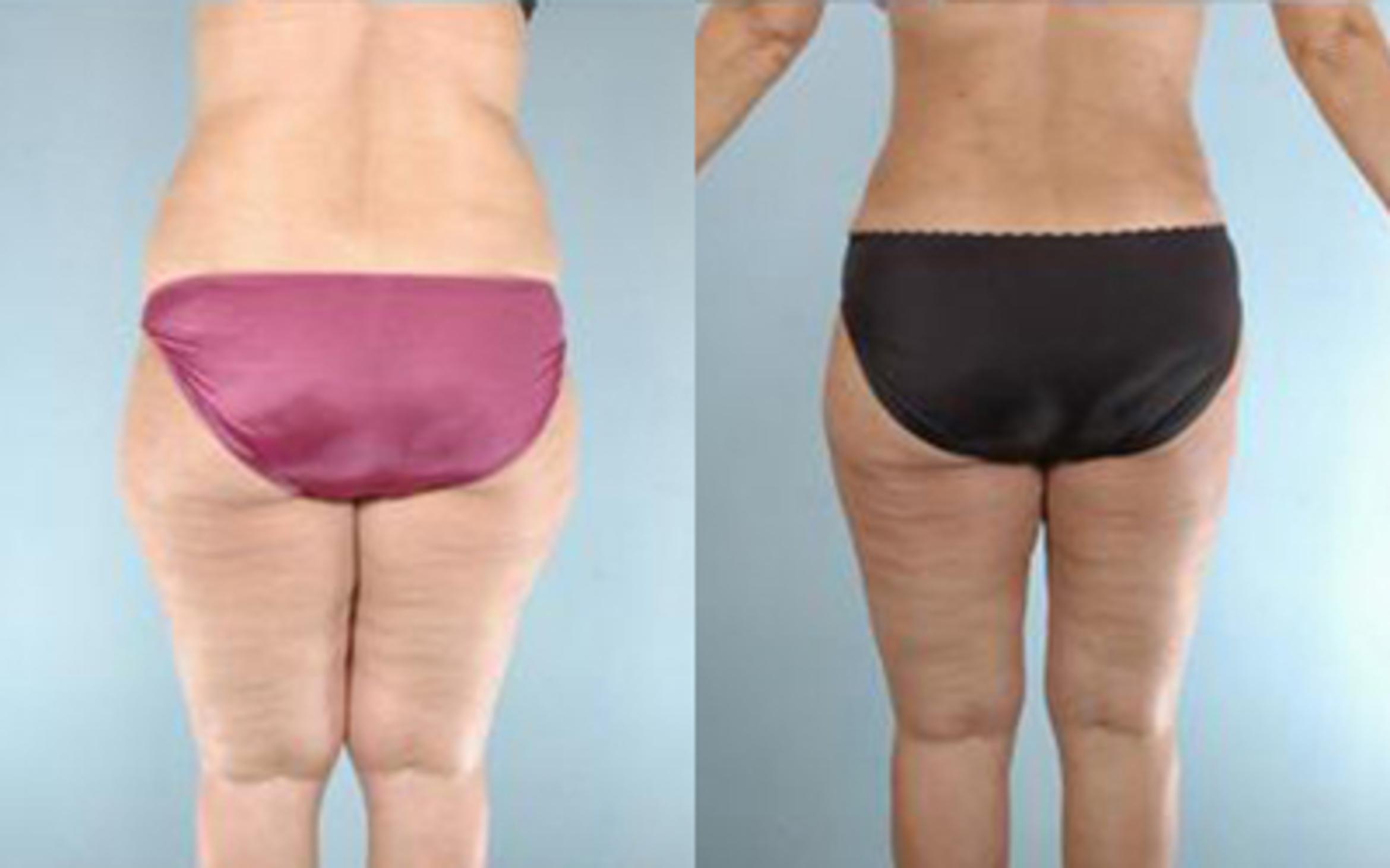 Before & After Tummy Tuck Case 21 View 4 View in Houston, TX