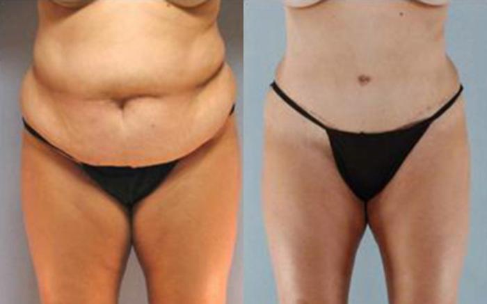 Before & After Tummy Tuck Case 22 View 1 View in Houston, TX