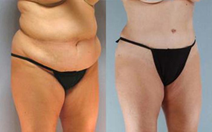 Before & After Tummy Tuck Case 22 View 2 View in Houston, TX