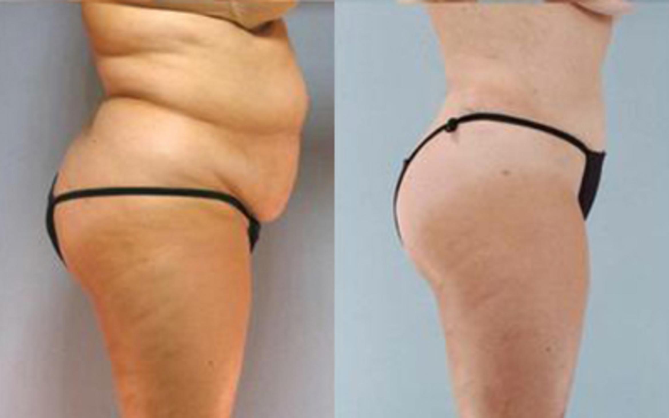 Before & After Tummy Tuck Case 22 View 3 View in Houston, TX