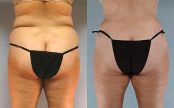 Before & After Tummy Tuck Case 22 View 4 View in Houston, TX