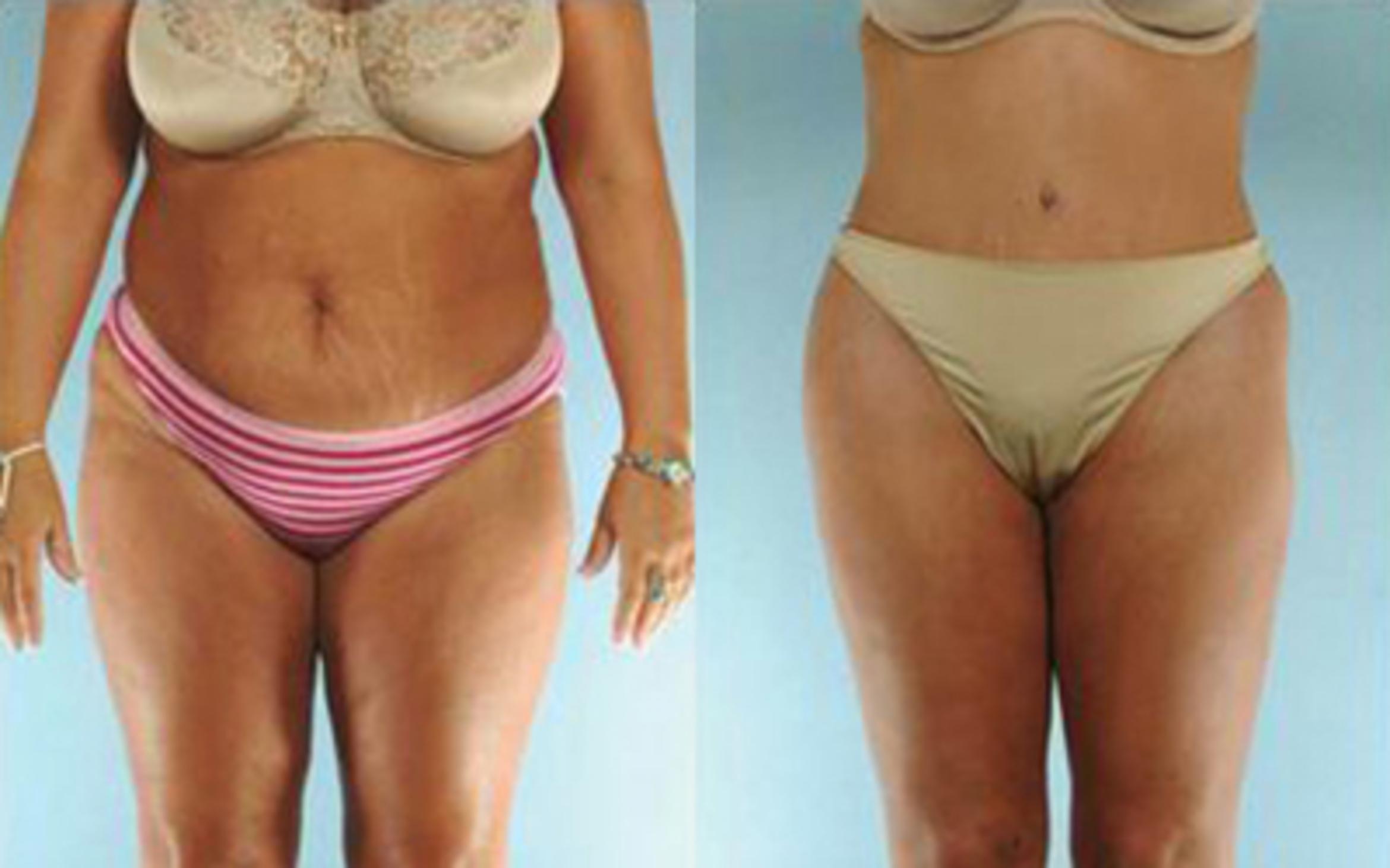 Before & After Tummy Tuck Case 23 View 1 View in Houston, TX