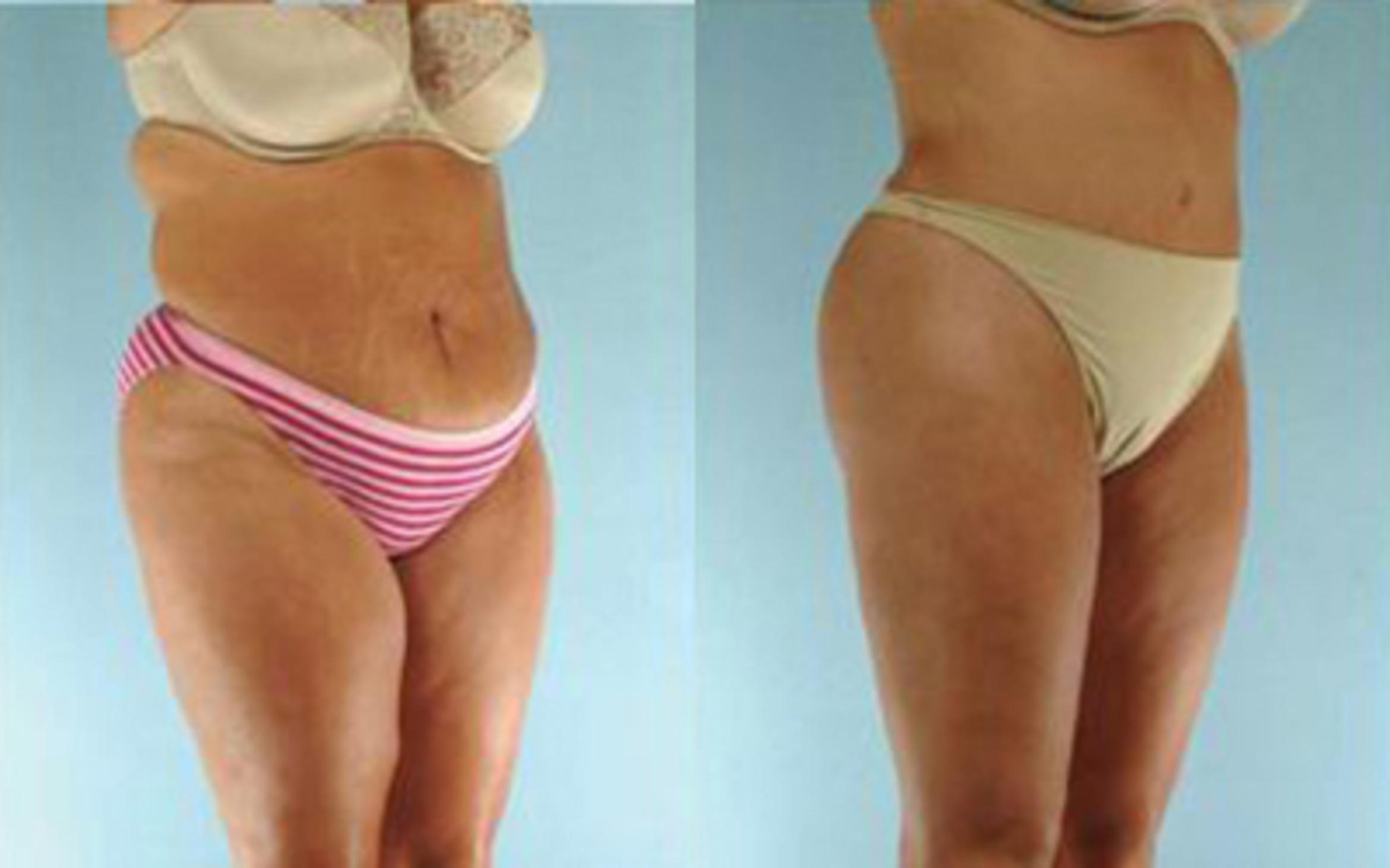 Before & After Tummy Tuck Case 23 View 2 View in Houston, TX
