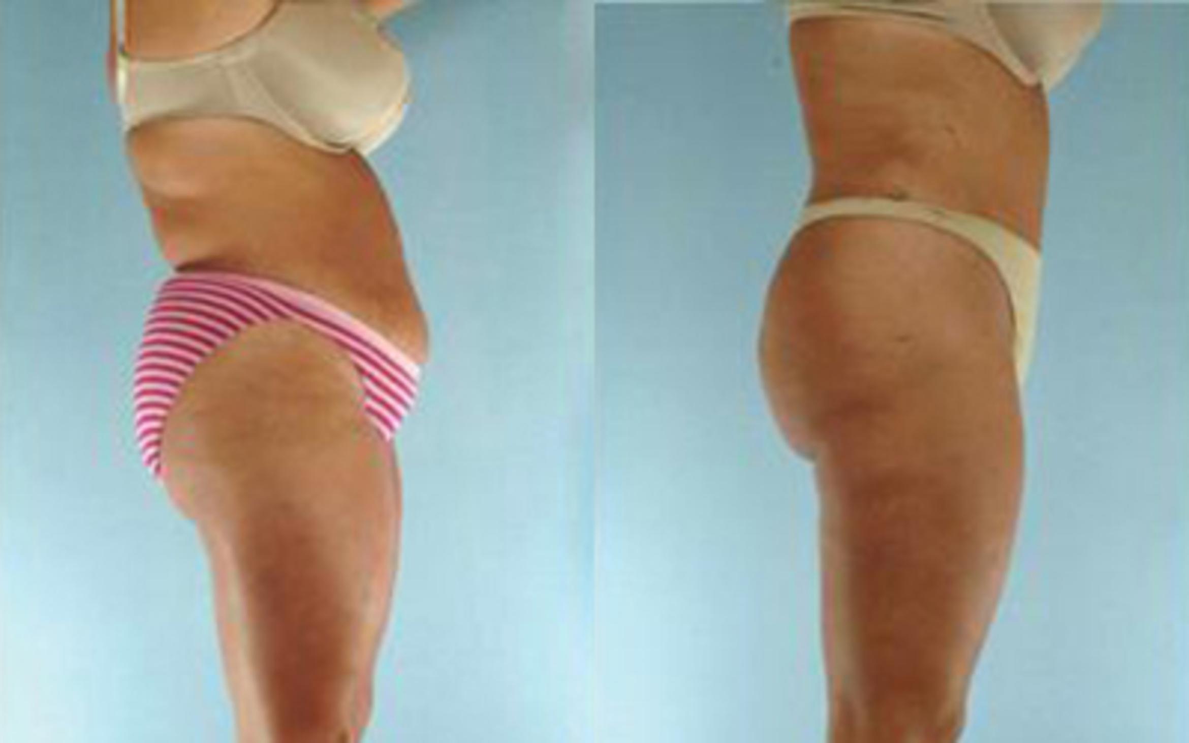 Before & After Tummy Tuck Case 23 View 3 View in Houston, TX