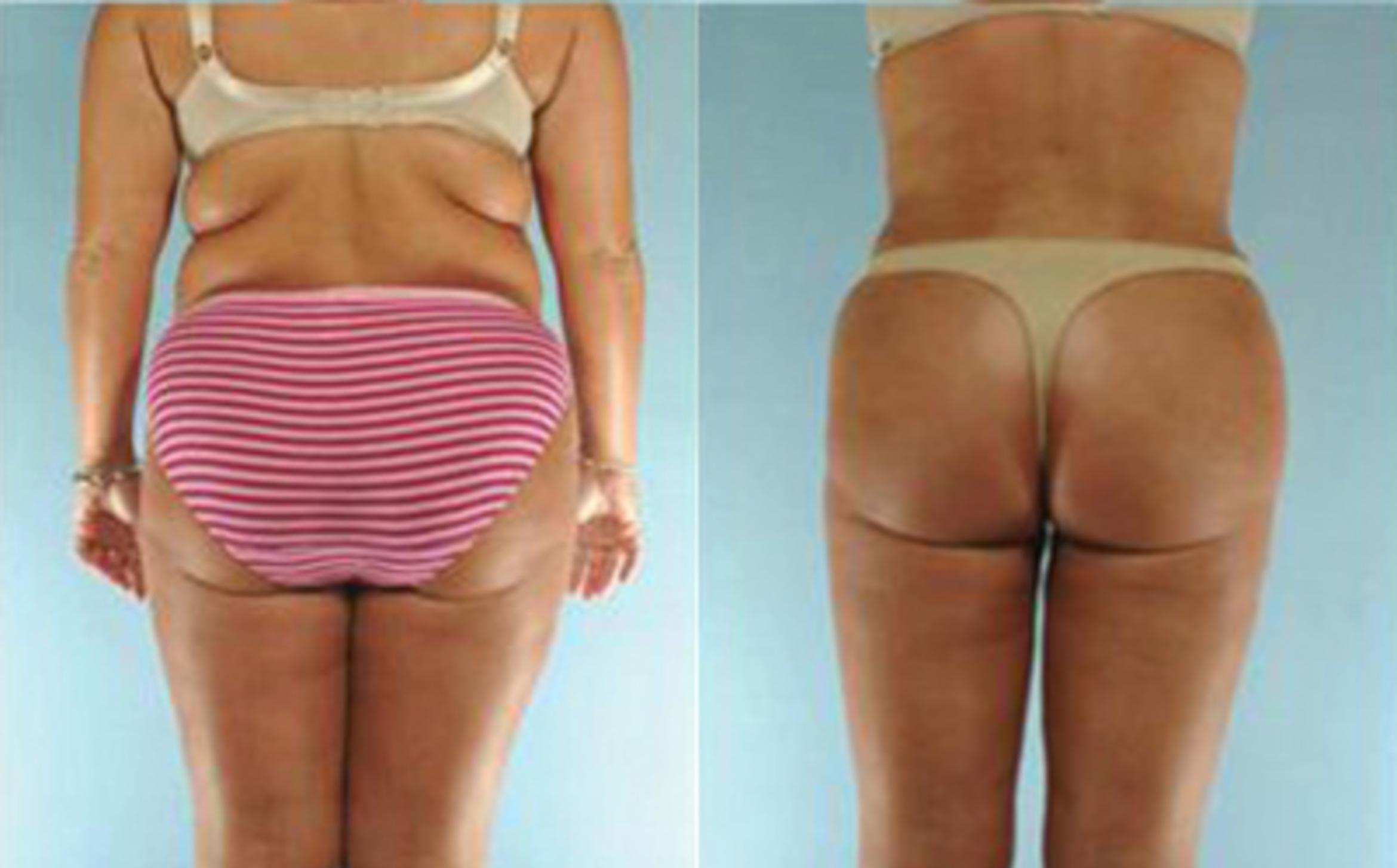 Before & After Tummy Tuck Case 23 View 4 View in Houston, TX