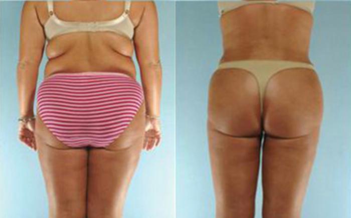 Before & After Tummy Tuck Case 23 View 4 View in Houston, TX