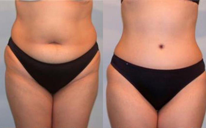 Before & After Tummy Tuck Case 24 View 1 View in Houston, TX