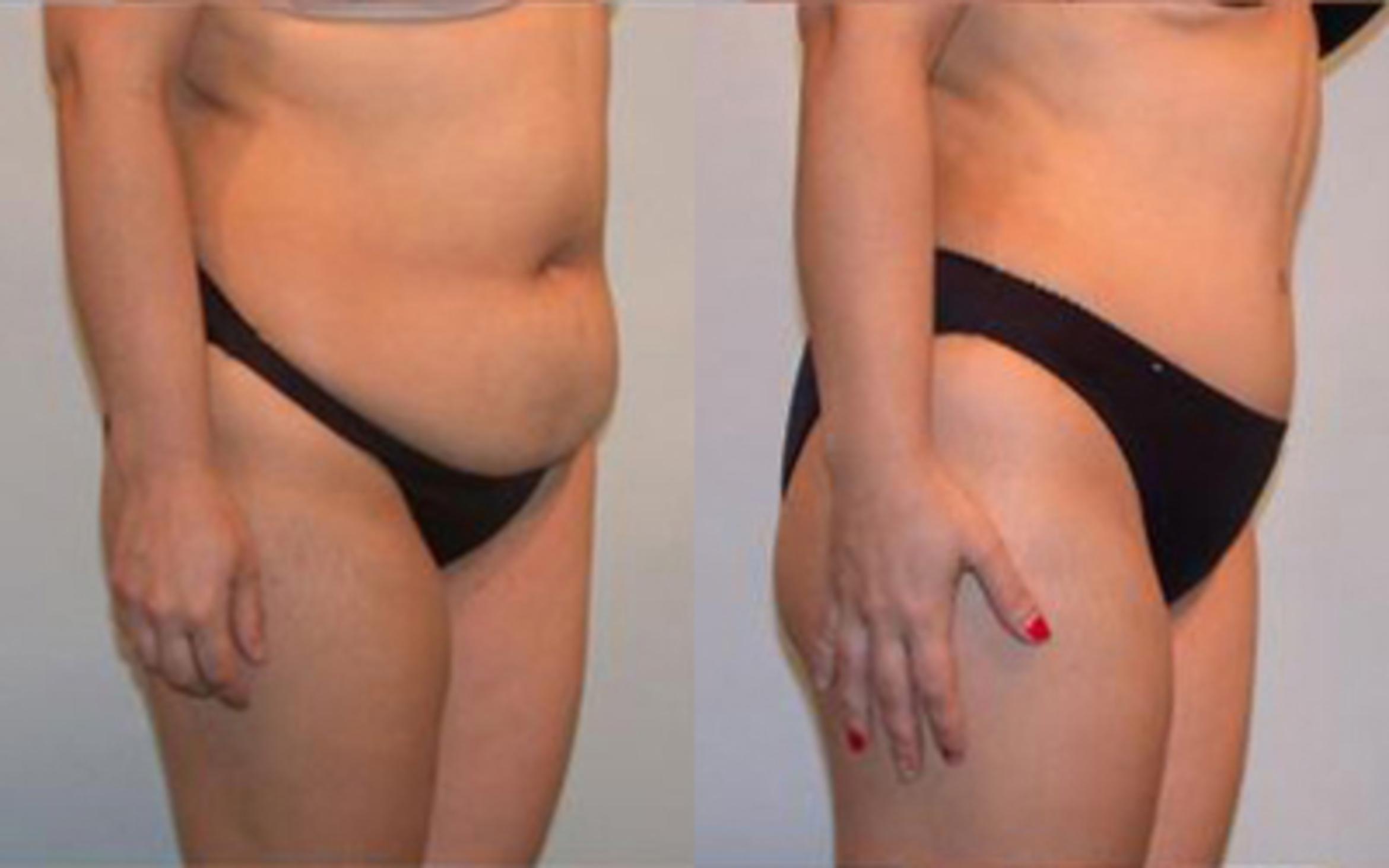 Before & After Tummy Tuck Case 24 View 2 View in Houston, TX