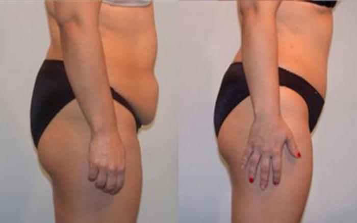 Before & After Tummy Tuck Case 24 View 3 View in Houston, TX