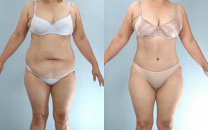 Before & After Tummy Tuck Case 25 View 1 View in Houston, TX