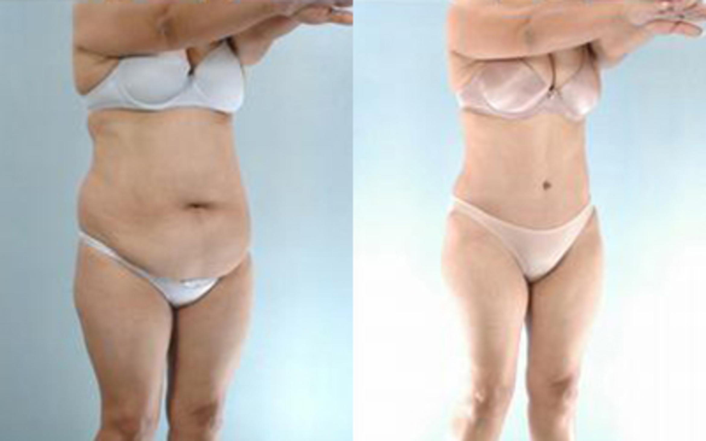 Before & After Tummy Tuck Case 25 View 2 View in Houston, TX