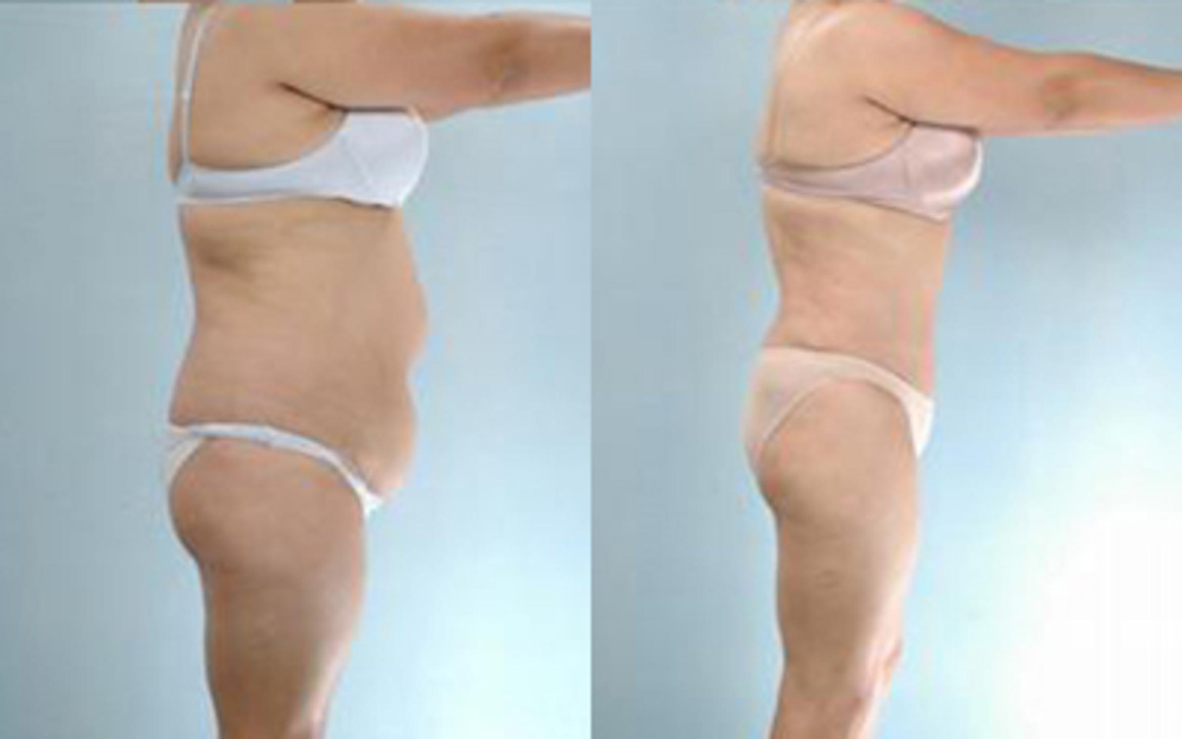 Before & After Tummy Tuck Case 25 View 3 View in Houston, TX