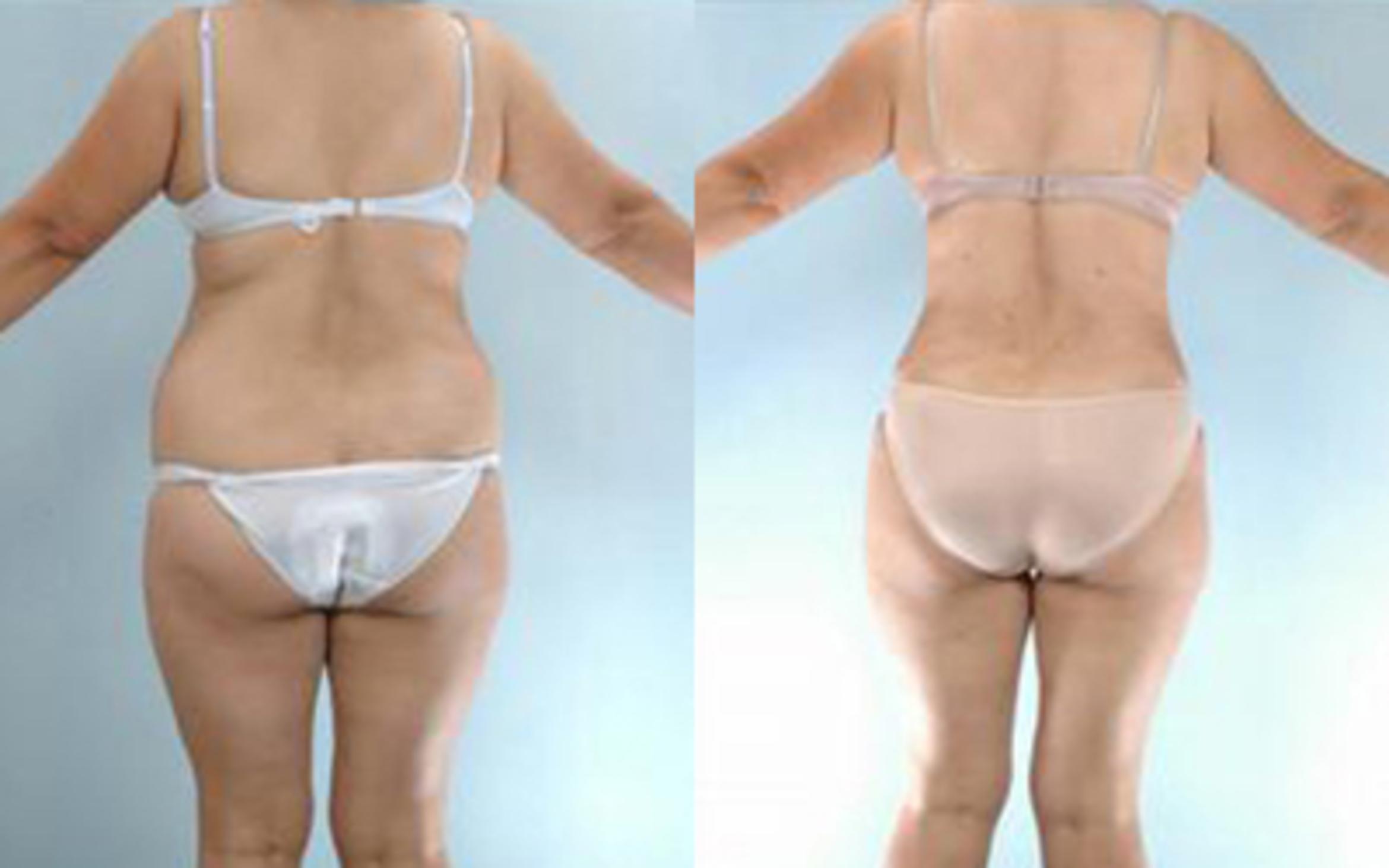 Before & After Tummy Tuck Case 25 View 4 View in Houston, TX