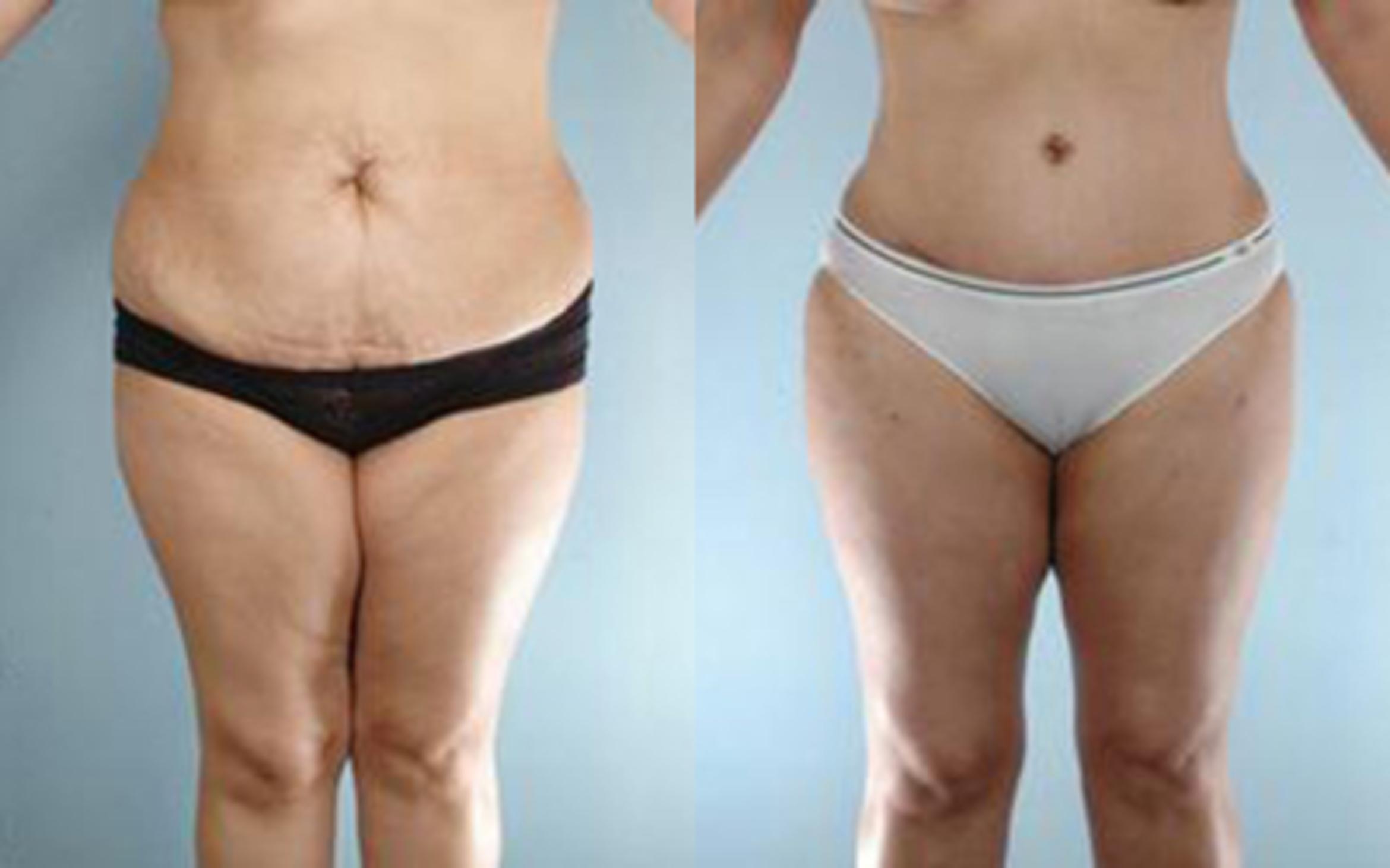 Before & After Tummy Tuck Case 26 View 1 View in Houston, TX