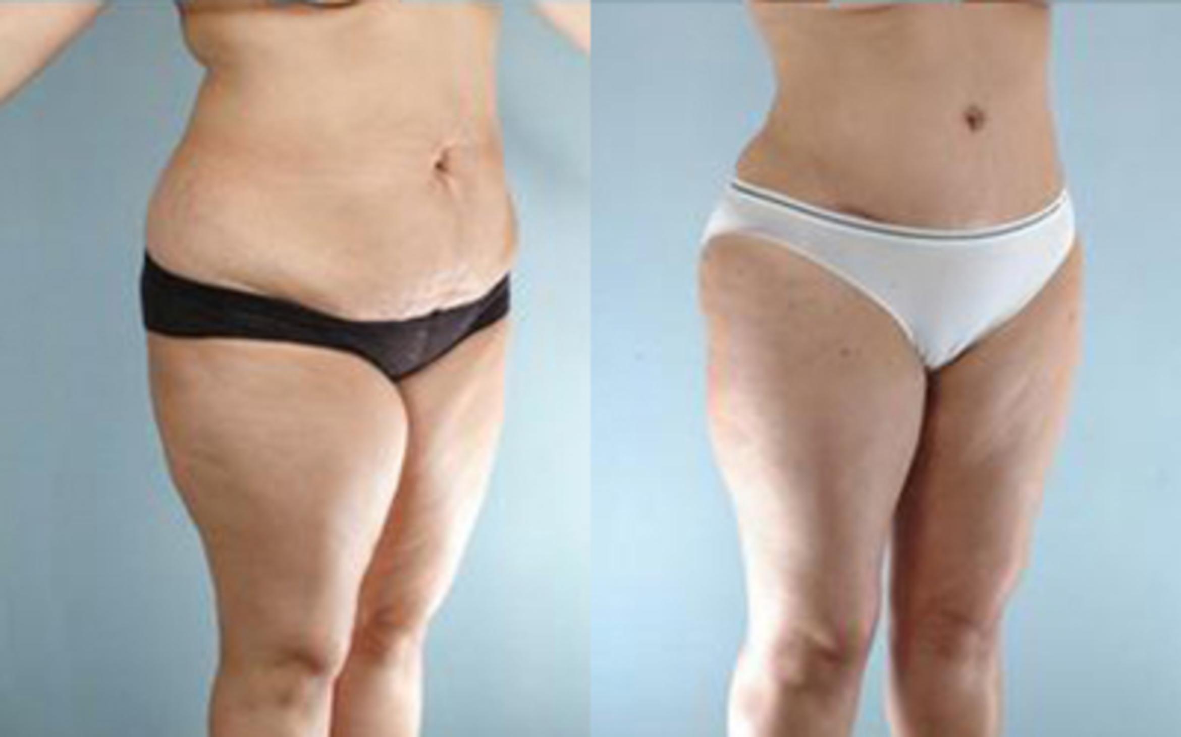 Before & After Tummy Tuck Case 26 View 2 View in Houston, TX