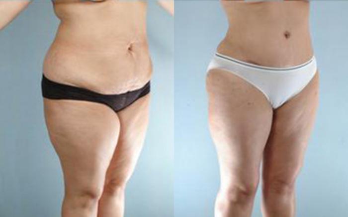 Before & After Tummy Tuck Case 26 View 2 View in Houston, TX