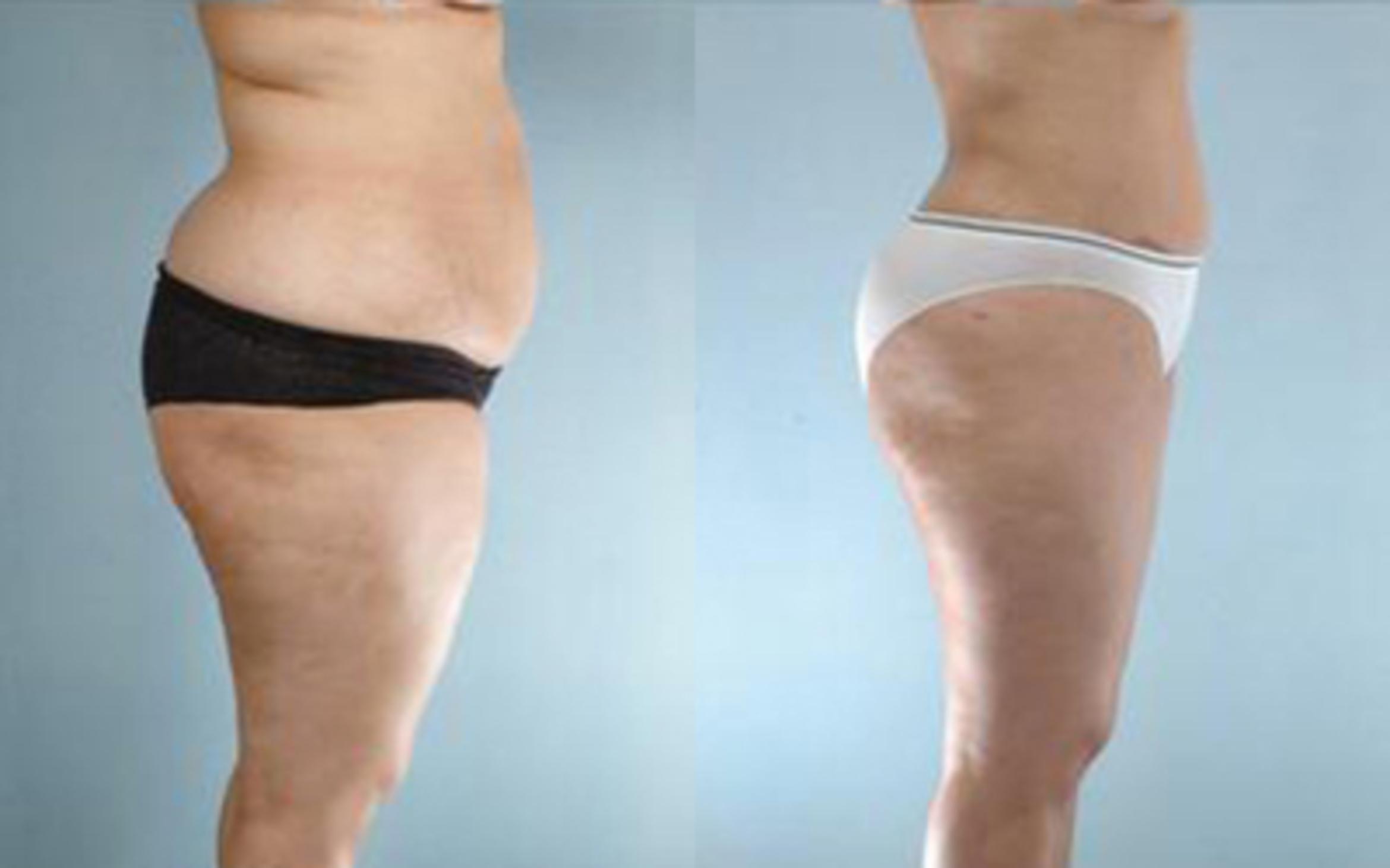 Before & After Tummy Tuck Case 26 View 3 View in Houston, TX