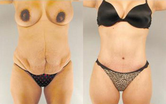 Before & After Tummy Tuck Case 27 View 1 View in Houston, TX