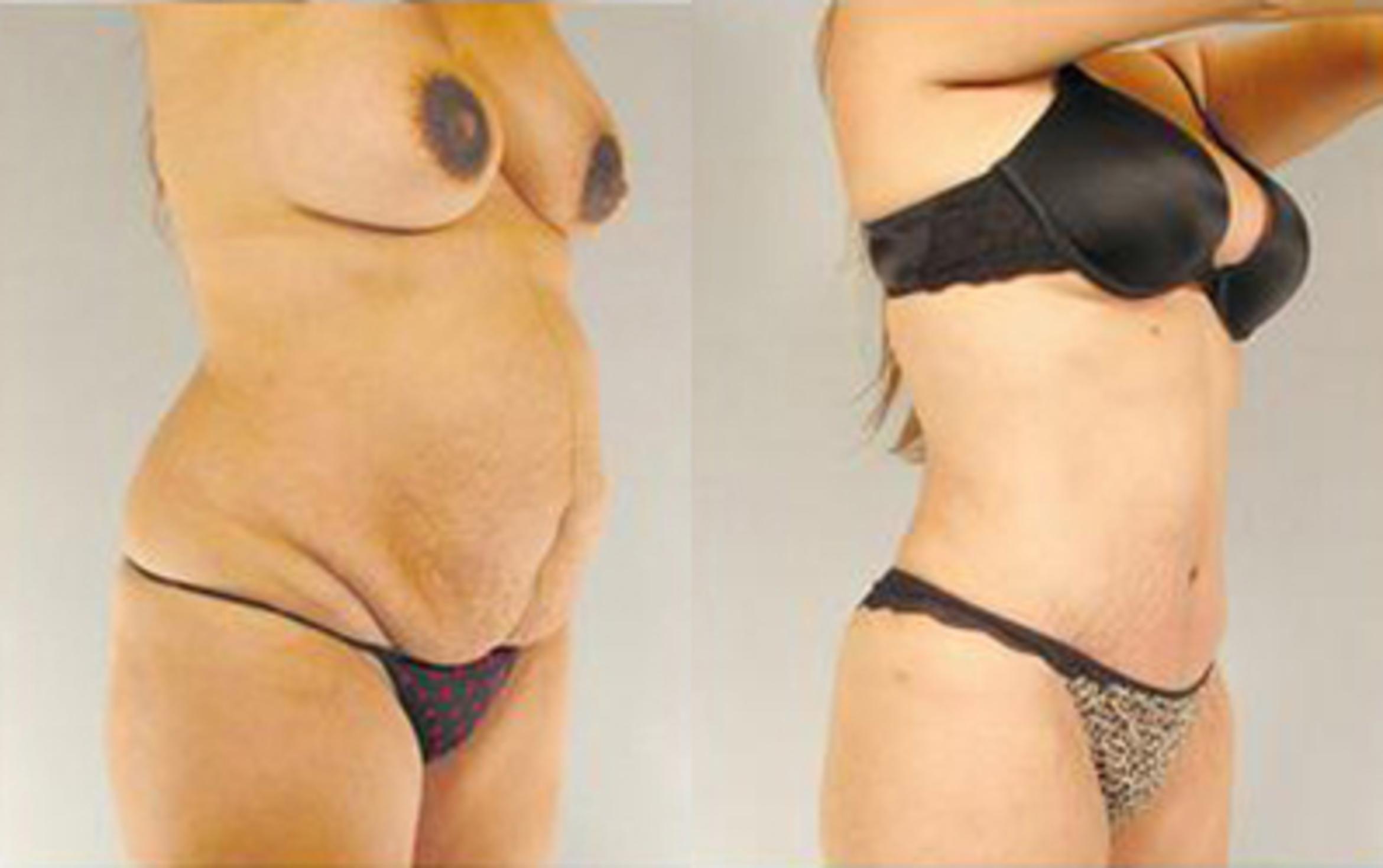 Before & After Tummy Tuck Case 27 View 2 View in Houston, TX
